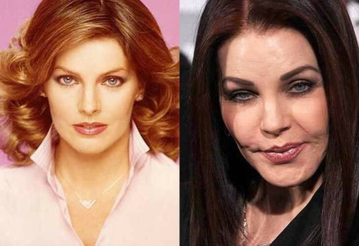 Celebrity plastic surgery before and after
