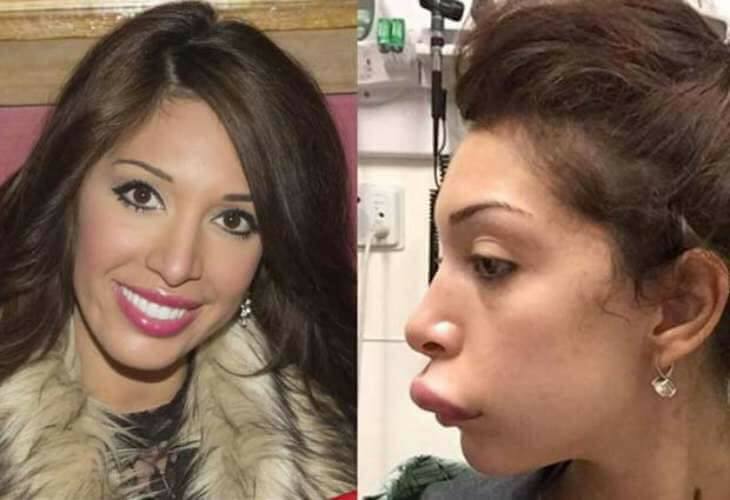 Celebrity plastic surgery before and after