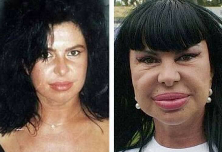 Celebrity plastic surgery before and after