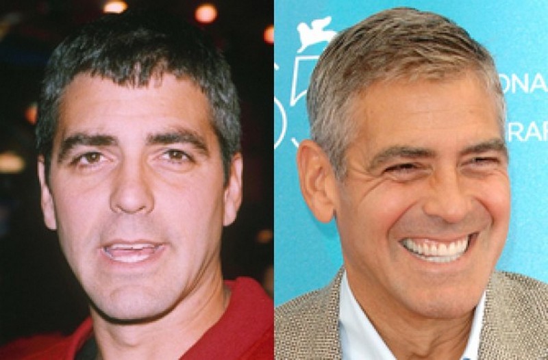 Hollywood Celebrities Before After
