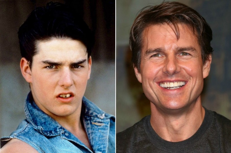 Hollywood Celebrities Before After