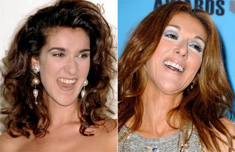 Hollywood Celebrities Before After
