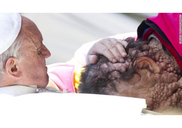 Pope Francis Blessing a Disfigured man 
