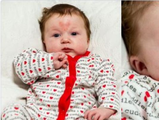 Baby conceived on Valentines Day was born with a heart shape on her forehead