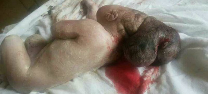 ولادة طفل بـ3 رؤوس في جنوب لبنان