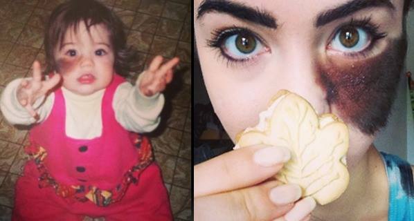 Cassandra Naud was born with a hairy birthmark under her left eye