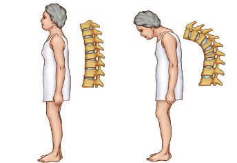 From Osteopenia to Osteoporosis…how to avoid them? Which foods to consume, which ones to avoid?