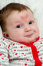 Baby conceived on Valentines Day was born with a heart shape on her forehead