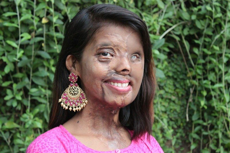 Shamed for having a burned face once, 23-year-old Anmol now rehabilitates acid attack survivors