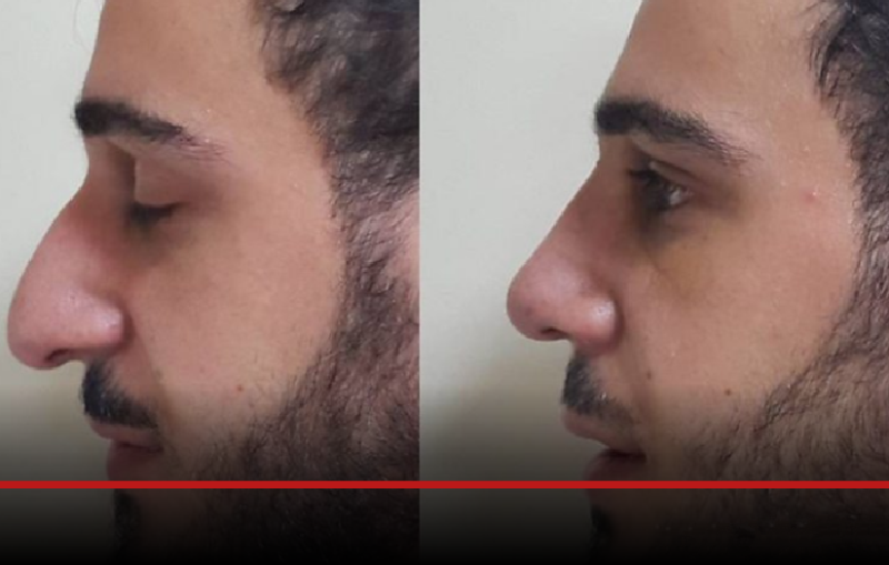 In Video: The Middle Eastern men having nose jobs