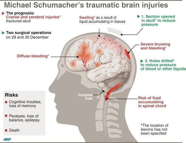Michael Schumacher still comatose in French hospital