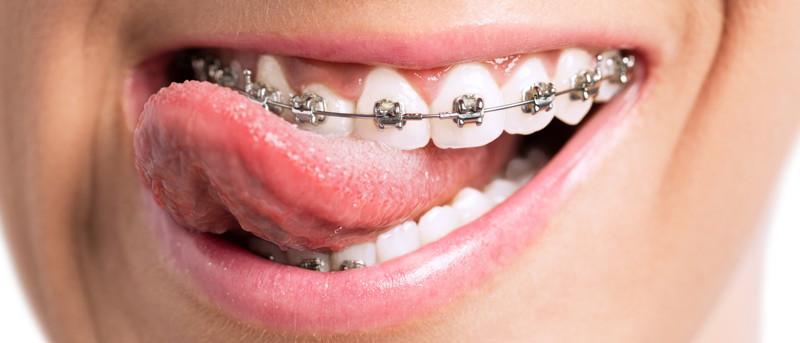 5 Most Embarrassing Braces Stories