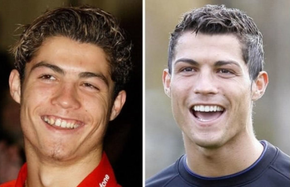 10 Celebrities Before & After Cosmetic Surgery 