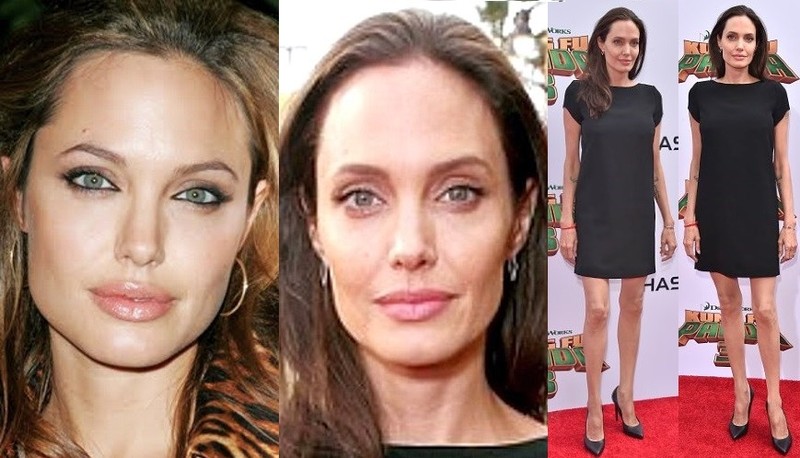 Is Angelina Jolie really suffering from anorexia
