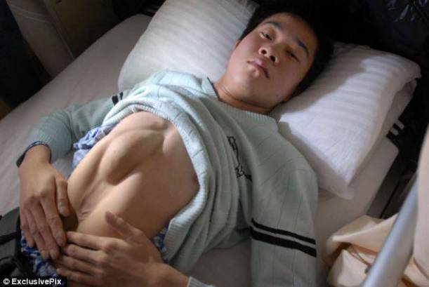Huang Rongming Undergoes Corrective Surgery