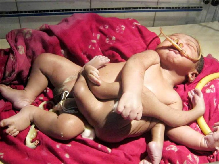 Baby Born With Eight Limbs Considered god in India