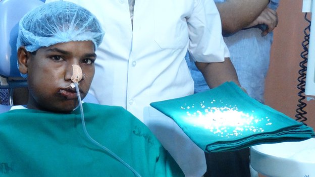 India doctors remove 232 teeth from boys mouth