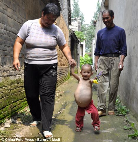 Pregnant one year old girl has unborn twin's foetus removed  