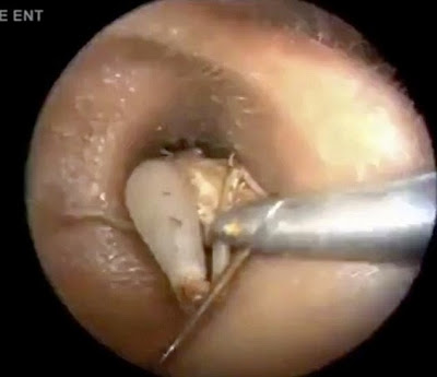 Doctor Pulls Three Inch Cricket Alive From Patient s Inner Ear