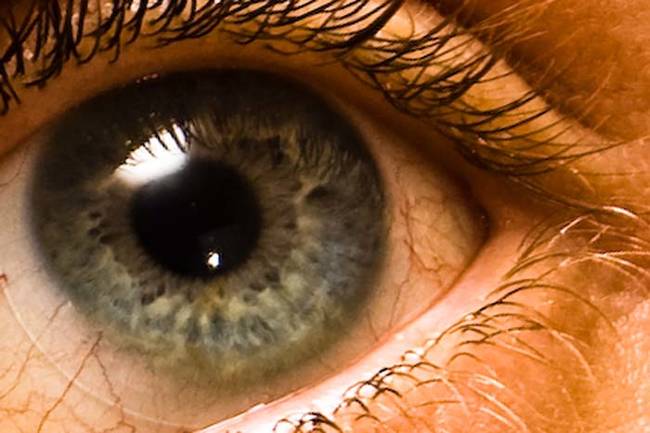 What Happened to this girl who left her contact Lenses in for 6 months