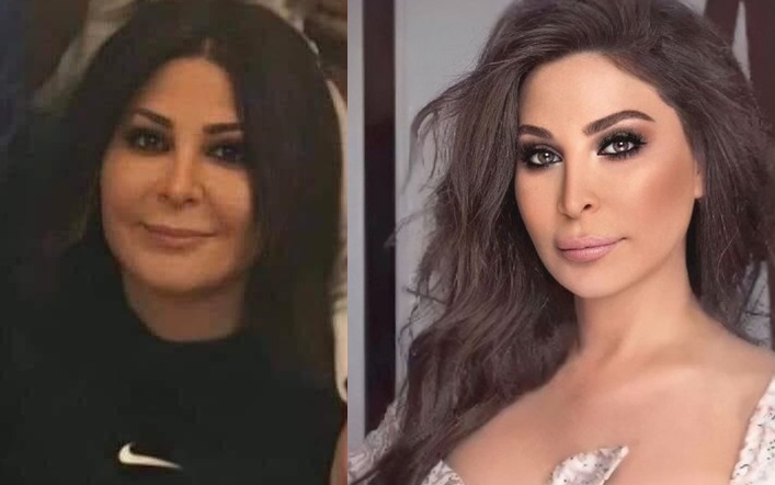Elissa's Lip Fillers are Gone