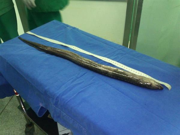 A Huge LIVE Fish Removed From A Man s Intestine 