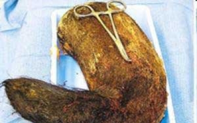 Doctors Remove Nine Pound Hairball From Teen's Stomach