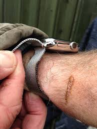 Man burns his wrist cause of apple watch