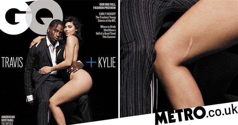 Kylie Jenner Reveals The Reasons Behind The Scar on Her Leg