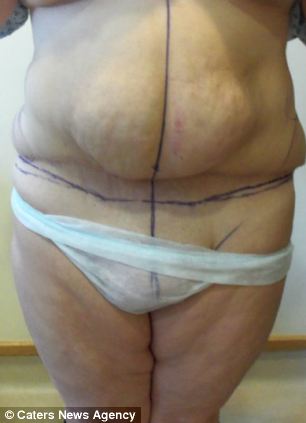 Woman was left with flap of skin dangling between her legs after tummy tuck operation