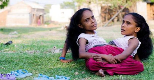 Conjoined Sisters Find Love In The Arms Of One Man